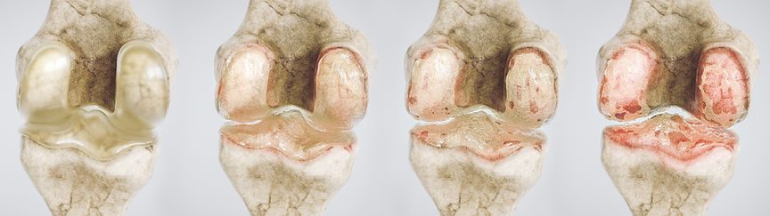 Osteoarthritis Physiotherapy treatment in Kenilworth, Leamington Spa, Warwick, Solihull