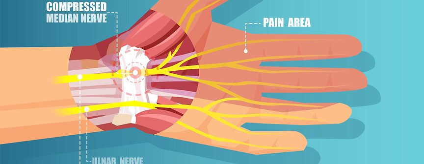 Why MSK Is A Great Carpal Tunnel Syndrome Treatment