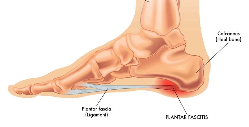 Plantar Fasciitis Treatment in Kenilworth, Leamington Spa, Warwick and Solihull