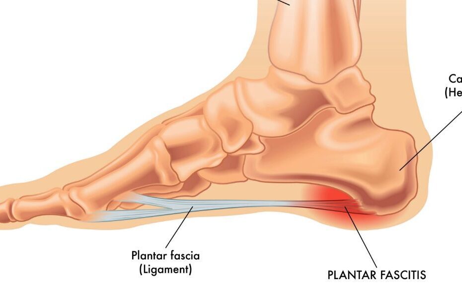 Free plantar fasciitis sales