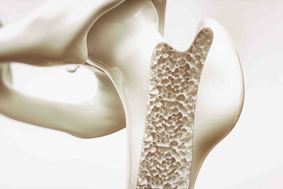 Bone Density and Exercise. Kenilworth Physiotherapy and Sports Therapy.