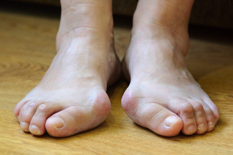 Person standing barefoot to assess their feet alignment and arch support. The Reinge Physiotherapy Clinic in Kenilworth